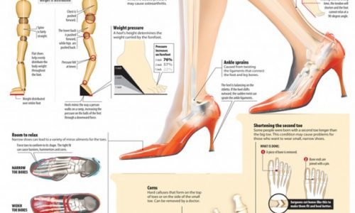 High-Heel Hazards