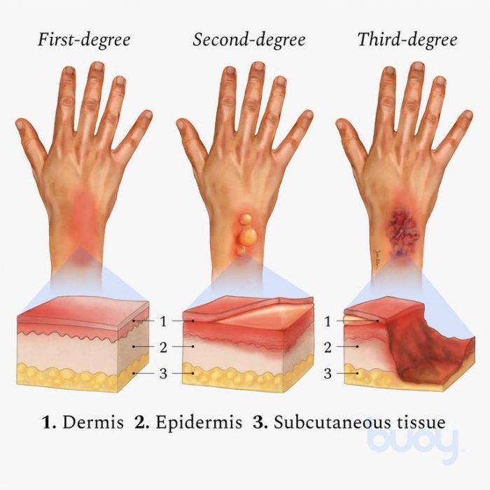 Types Of Burns