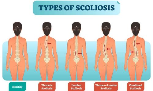 Types of Scoliosis